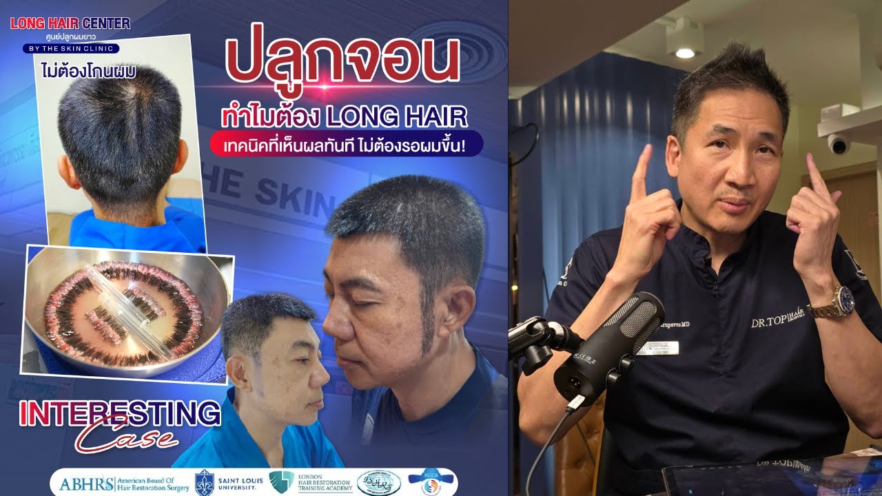 Cấy râu ria 3D Long Hair FUI tại Dr.Top Hair Hospital Thái Lan