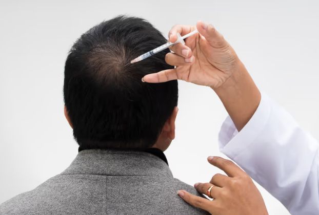 REGENERA Micrograft tại Dr.Top Hair Hospital – Giải pháp không cấy ghép