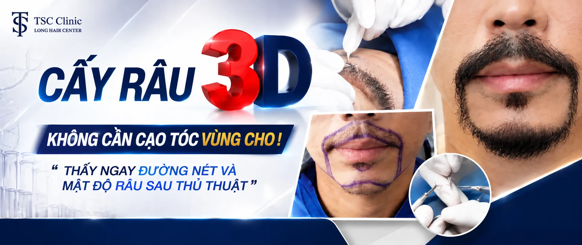Cấy râu ria 3D Long Hair FUI tại Dr.Top Hair Hospital Thái Lan