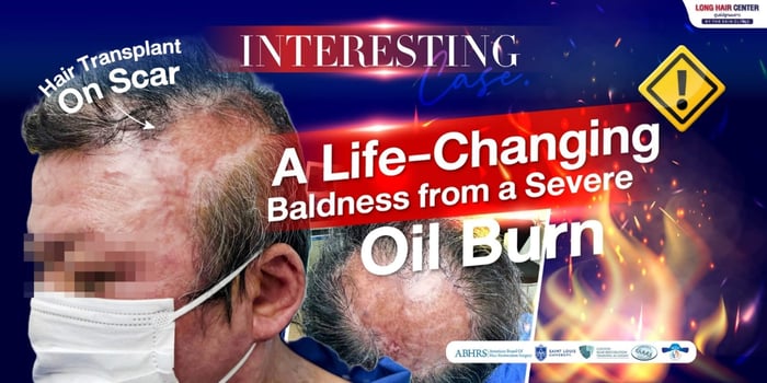 Hair Transplant on Scar. A Life-Changing: Baldness from a Severe Oil Burn