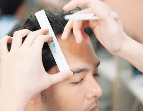 Quy trình cấy tóc kỹ thuật DHI Hair Transplant
