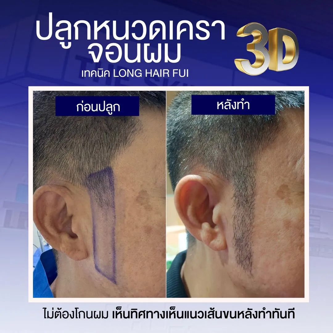 Review cấy râu ria 3D từ bệnh nhân thực không phải Influencer