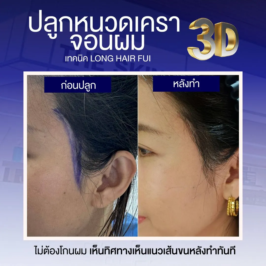 Review cấy râu ria 3D từ bệnh nhân thực không phải Influencer