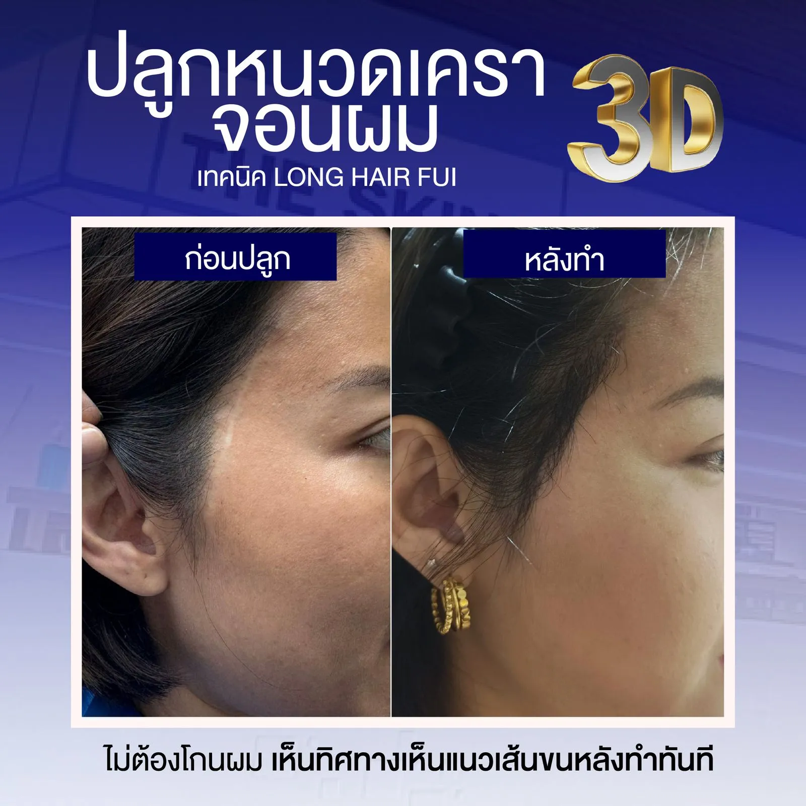 Review cấy râu ria 3D từ bệnh nhân thực không phải Influencer