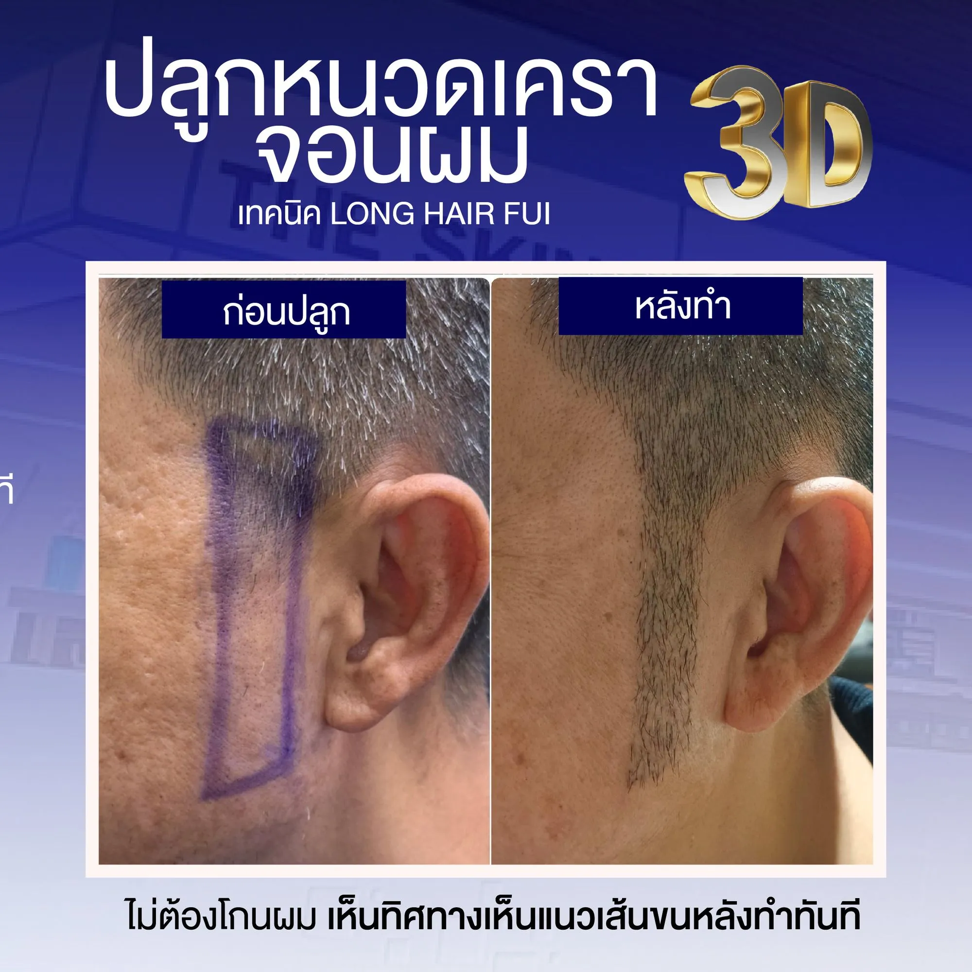 Review cấy râu ria 3D từ bệnh nhân thực không phải Influencer