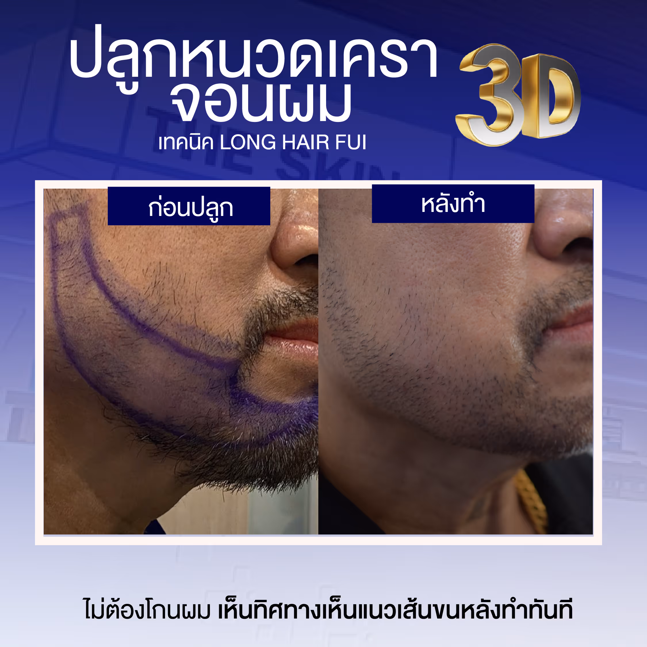 Review cấy râu ria 3D từ bệnh nhân thực không phải Influencer