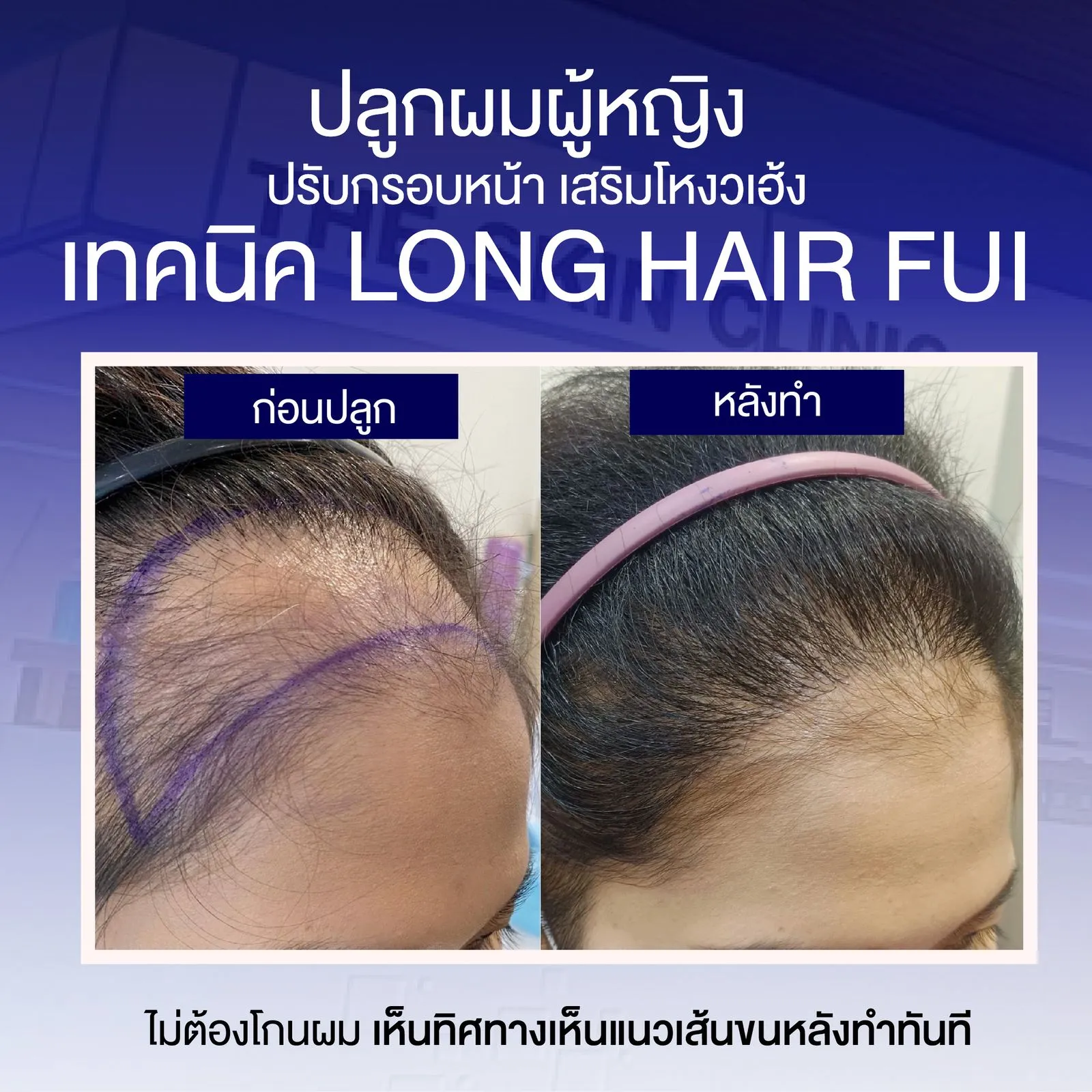 Review cấy tóc nữ Long Hair FUI tại Dr.Top Hair Hospital Thái Lan