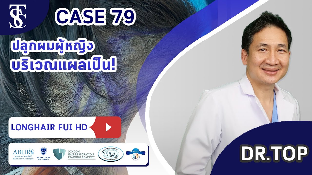 Cấy tóc nữ Long Hair FUI tại bệnh viện cấy tóc Dr. Top Hair Hospital