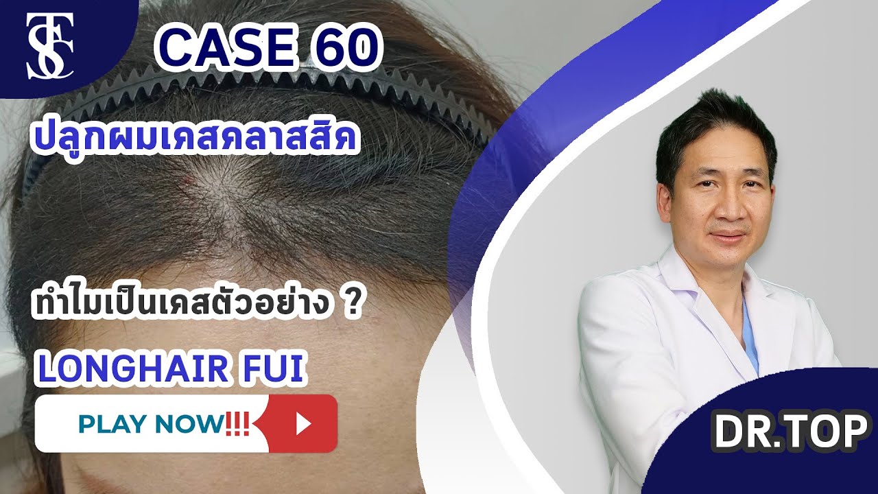 Hết vấn đề rụng tóc tóc thưa hói đầu điều trị được tại Dr.Top Hair Hospital by The Skin Clinic 
