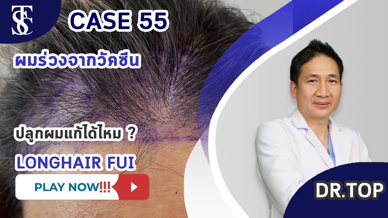 Hết vấn đề rụng tóc tóc thưa hói đầu điều trị được tại Dr.Top Hair Hospital by The Skin Clinic 