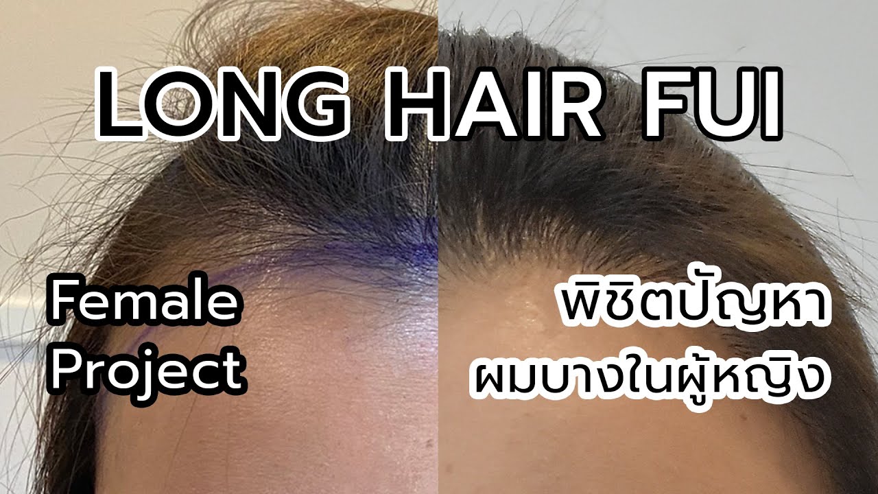 Hết vấn đề rụng tóc tóc thưa hói đầu điều trị được tại Dr.Top Hair Hospital by The Skin Clinic 