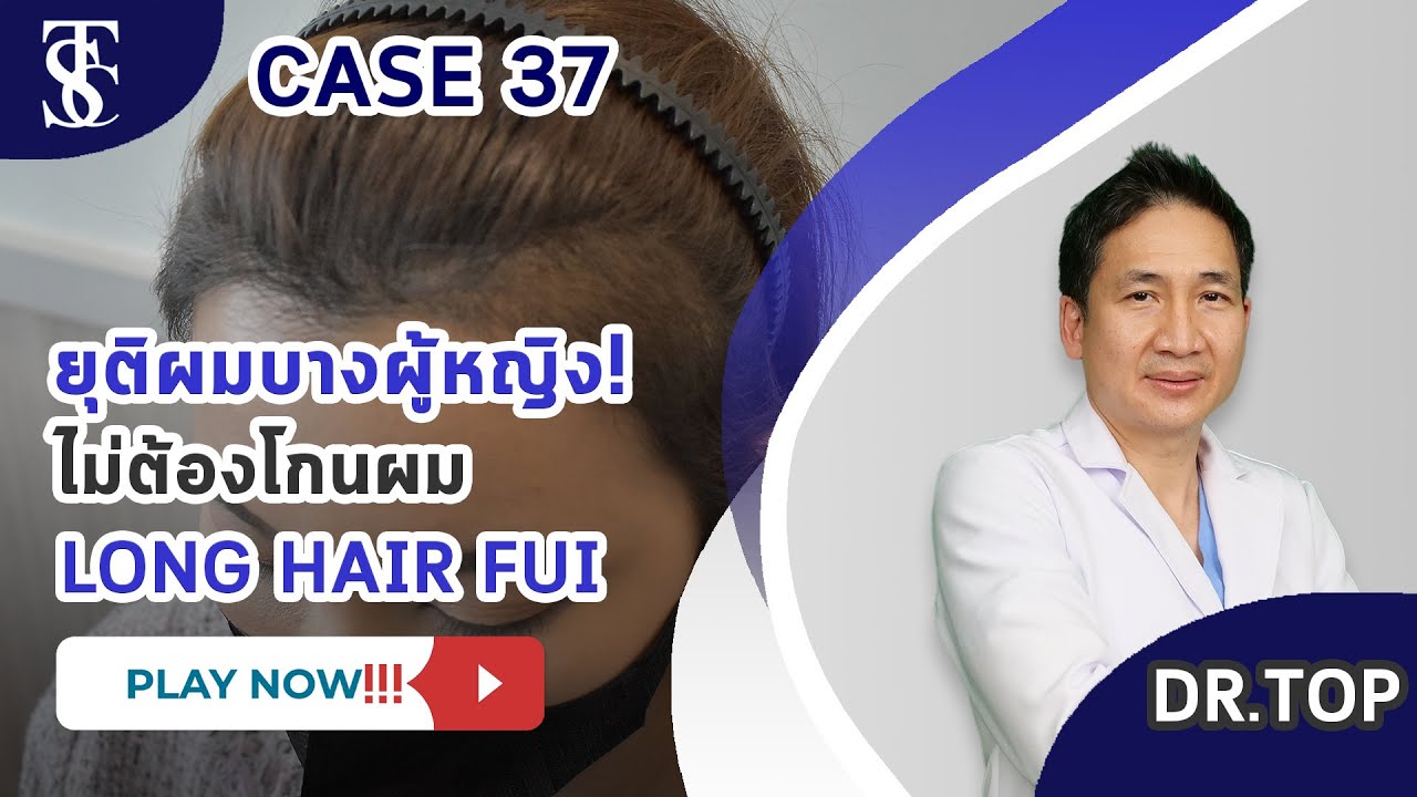 Hết vấn đề rụng tóc tóc thưa hói đầu điều trị được tại Dr.Top Hair Hospital by The Skin Clinic 