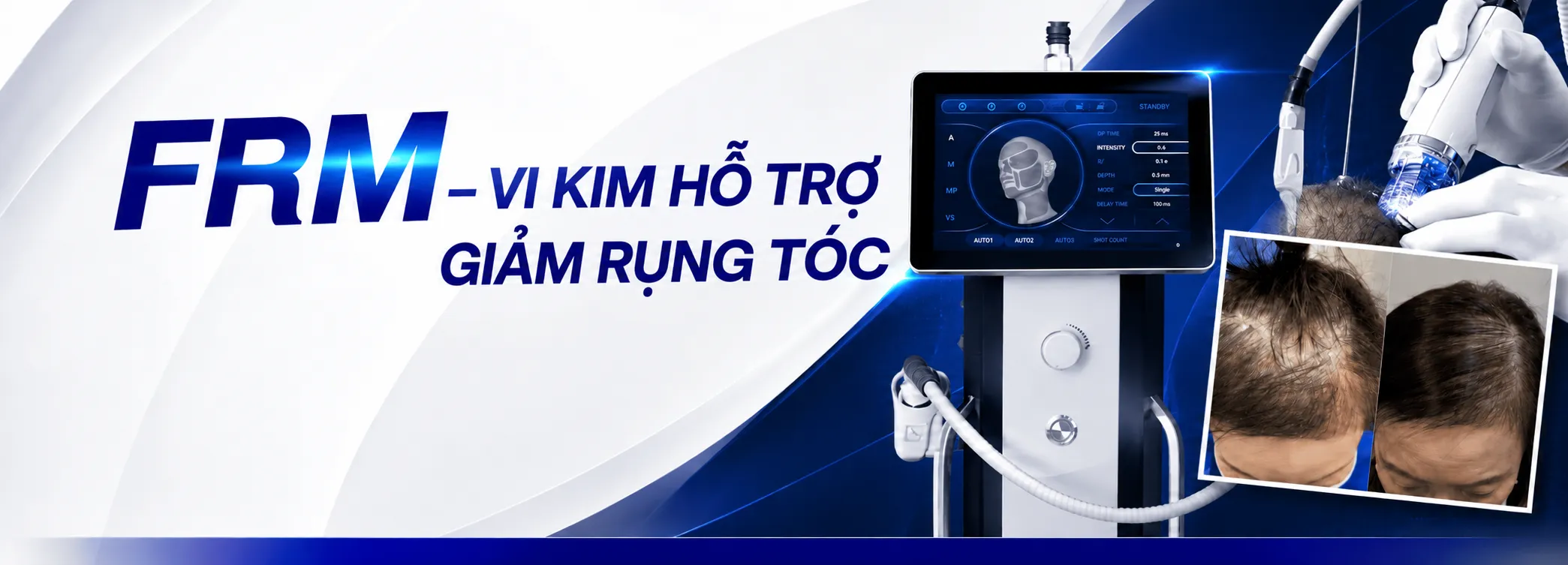 FRM Anti Hair Loss tại Dr.Top Hair Hospital – Chống rụng tóc hiệu quả