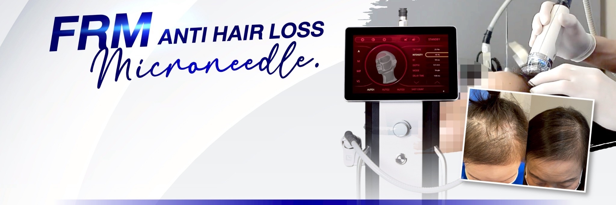 FRM Anti Hair Loss tại Dr.Top Hair Hospital – Chống rụng tóc hiệu quả