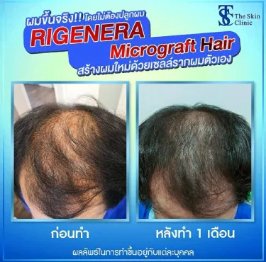 KẾT QUẢ SAU PHẪU THUẬT CẤY TÓC Bằng kỹ thuật RIGENERA MICROGRAFT HAIR  | The Skin Clinic