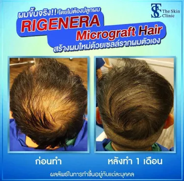 KẾT QUẢ SAU PHẪU THUẬT CẤY TÓC Bằng kỹ thuật RIGENERA MICROGRAFT HAIR  | The Skin Clinic