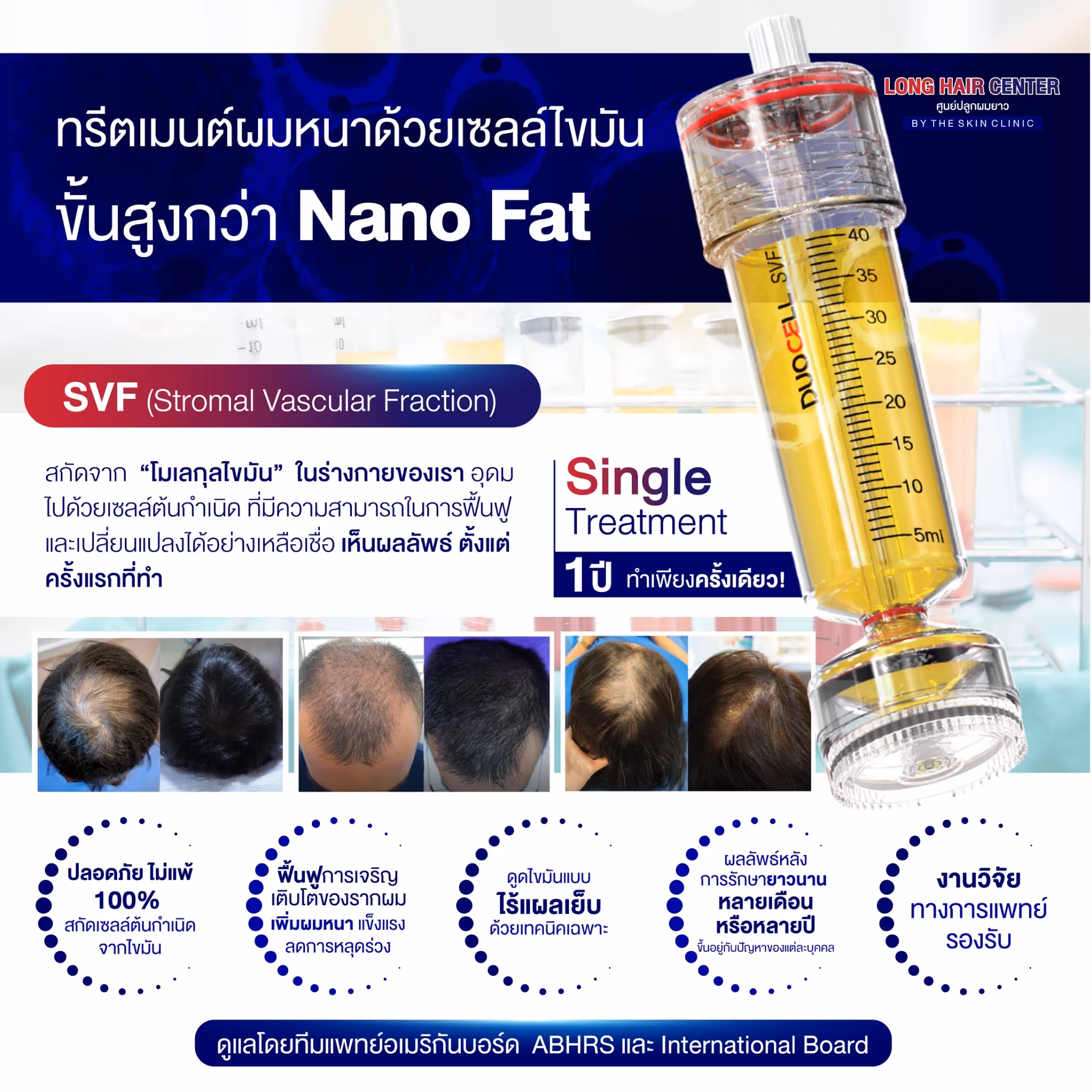 ALMI Nano Fat & SVF – Tăng mật độ tóc bằng tế bào mỡ