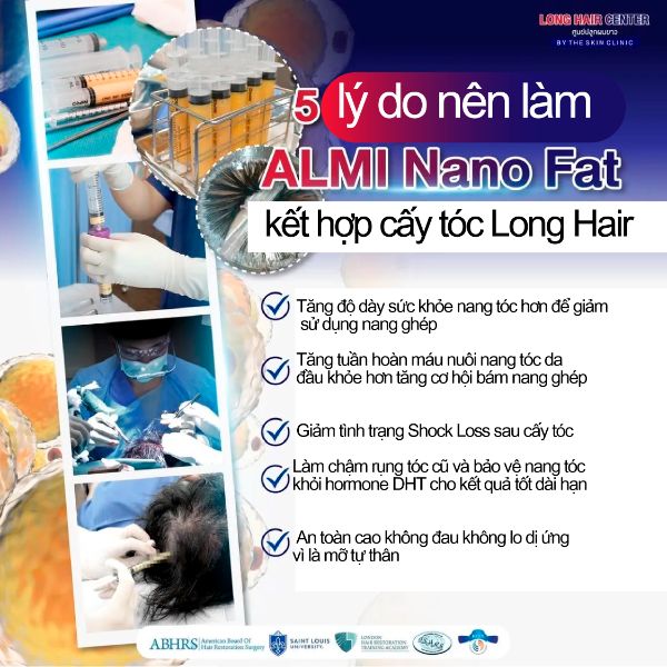 Tại sao phải cấy tóc Long Hair Transplant kết hợp ALMI Nanofat?