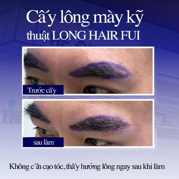 รีวิว ปลูกคิ้ว 3D Long Hair FUI ที่โรงพยาบาล ปลูกผม Dr.Top Hair Hospital