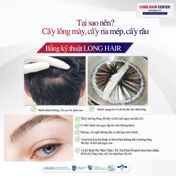 Cấy râu ria 3D Long Hair FUI tại Dr.Top Hair Hospital Thái Lan