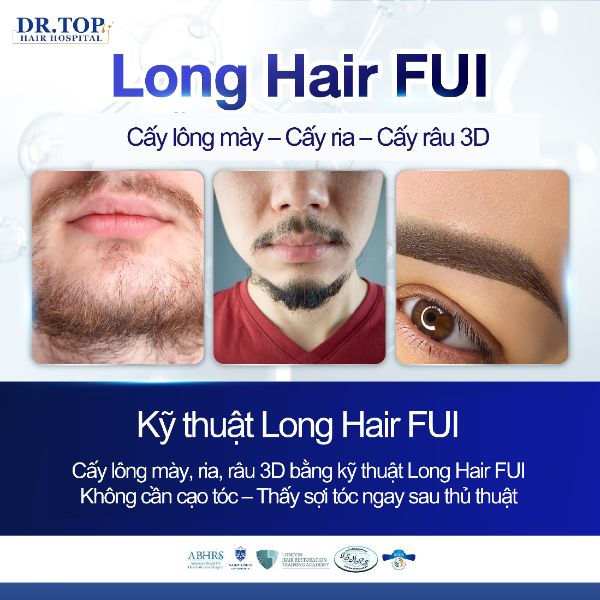 Cấy râu ria 3D Long Hair FUI tại Dr.Top Hair Hospital Thái Lan