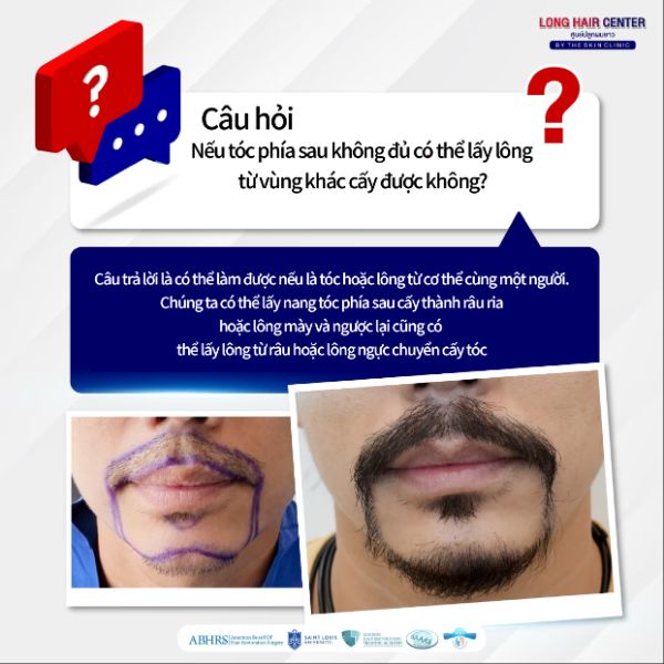 Cấy râu ria 3D Long Hair FUI tại Dr.Top Hair Hospital Thái Lan