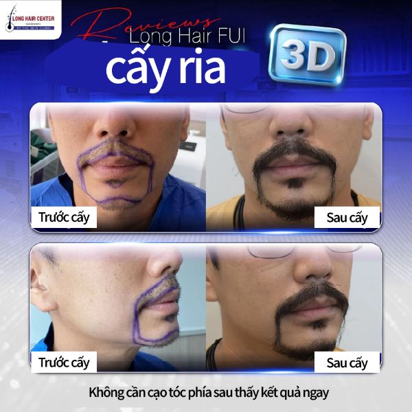 Review cấy râu ria 3D từ bệnh nhân thực không phải Influencer