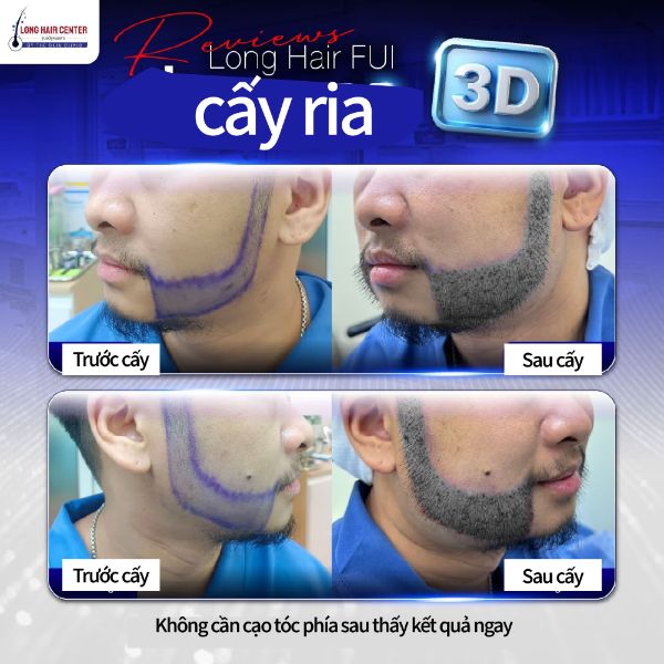 Review cấy râu ria 3D từ bệnh nhân thực không phải Influencer