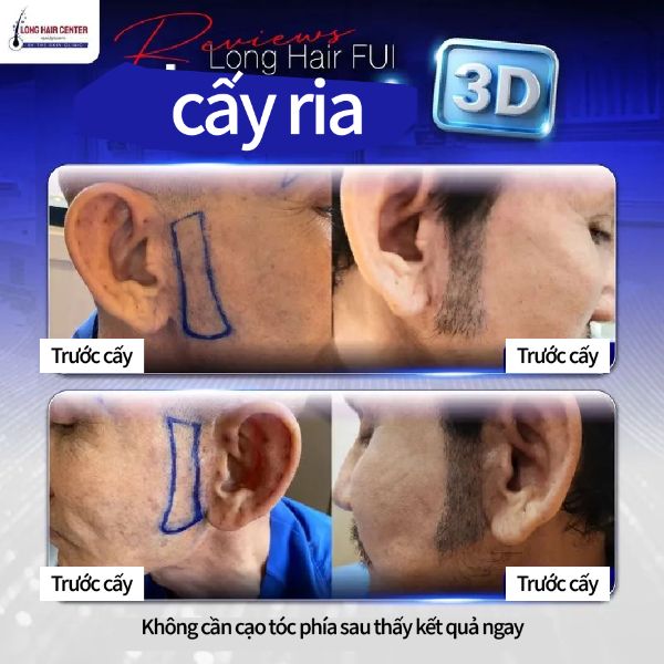 Review cấy râu ria 3D từ bệnh nhân thực không phải Influencer