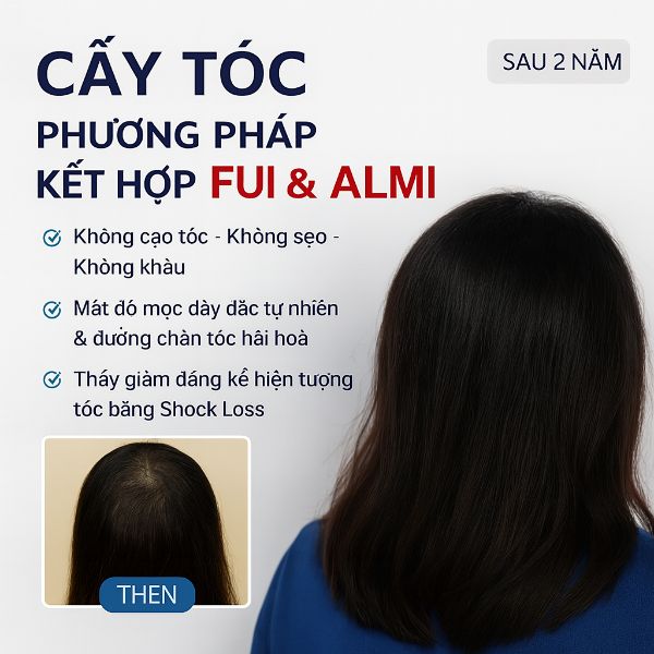 Cấy tóc nữ Long Hair FUI tại bệnh viện cấy tóc Dr. Top Hair Hospital