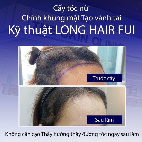 Cấy tóc nữ Long Hair FUI tại bệnh viện cấy tóc Dr. Top Hair Hospital