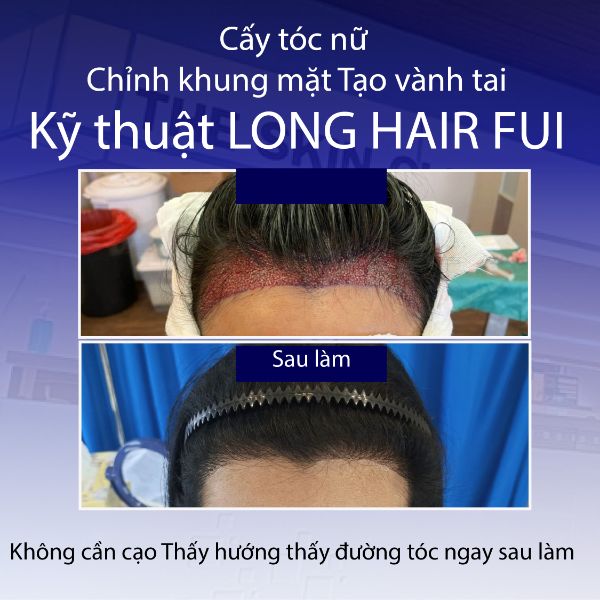Review cấy tóc nữ Long Hair FUI tại Dr.Top Hair Hospital Thái Lan