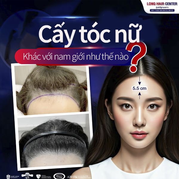 Cấy tóc nữ Long Hair FUI tại bệnh viện cấy tóc Dr. Top Hair Hospital