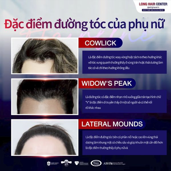 Cấy tóc nữ Long Hair FUI tại bệnh viện cấy tóc Dr. Top Hair Hospital