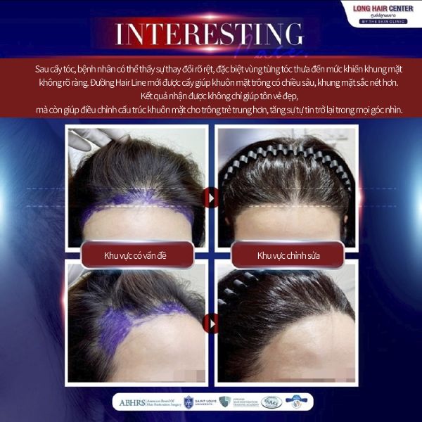 Cấy tóc nữ Long Hair FUI tại bệnh viện cấy tóc Dr. Top Hair Hospital