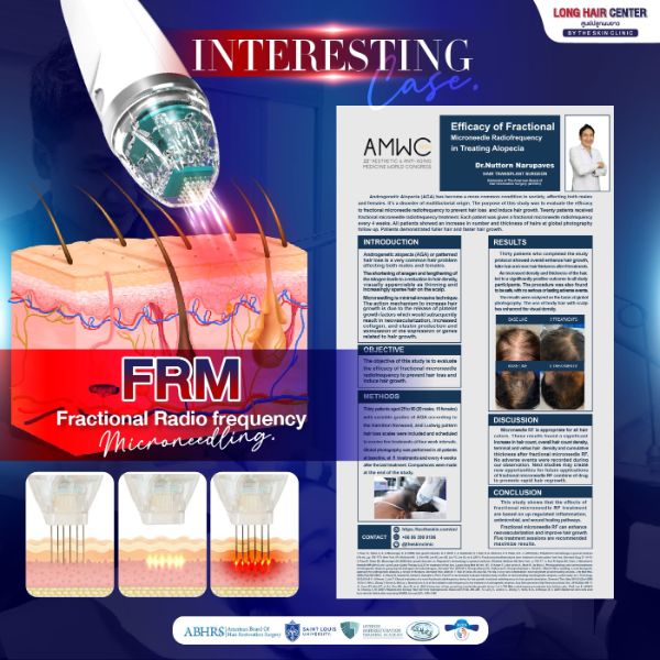 FRM Anti Hair Loss tại Dr.Top Hair Hospital – Chống rụng tóc hiệu quả