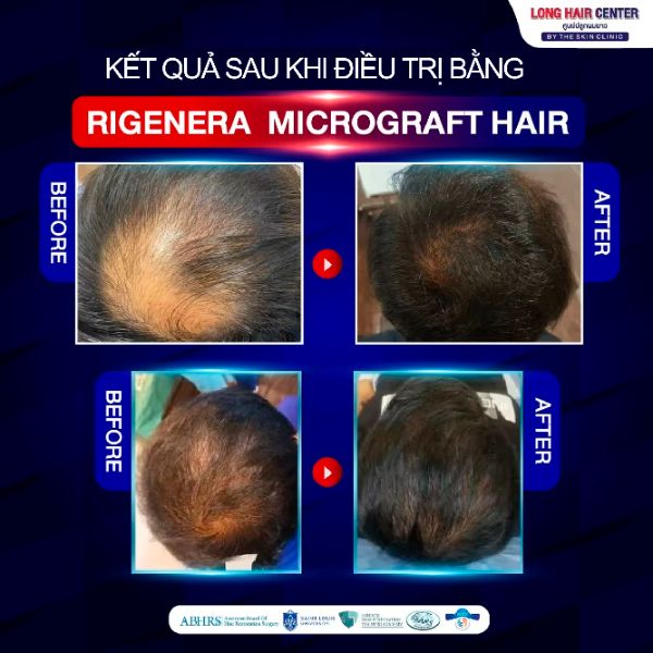 Regenera Micrograft Hair – cấy tóc Micrograft với công nghệ hiện đại, không cần cấy ghép nang tóc.