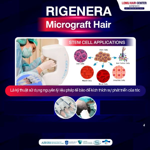 Regenera Micrograft Hair – cấy tóc Micrograft với công nghệ hiện đại, không cần cấy ghép nang tóc.