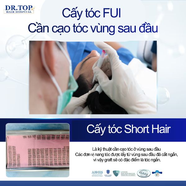 Cấy tóc FUE kiểu cạo tóc ngắn | The Skin Clinic