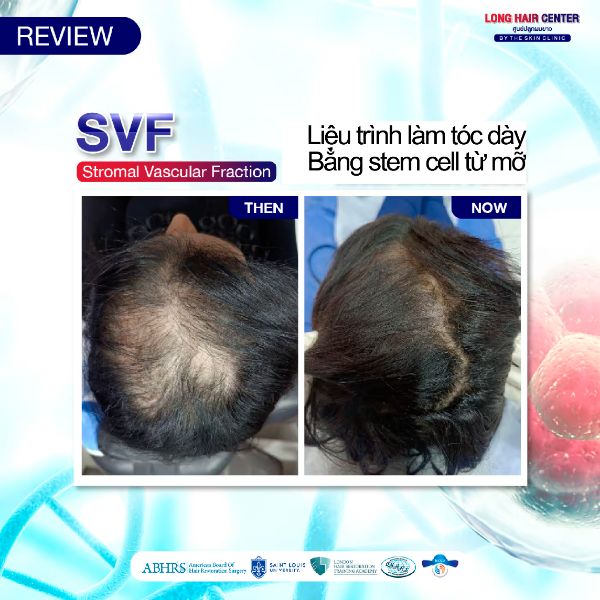 Review cấy tóc và điều trị bệnh nhân thực không chỉ có việc sử dụng Influencer