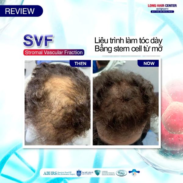 Review cấy tóc và điều trị bệnh nhân thực không chỉ có việc sử dụng Influencer