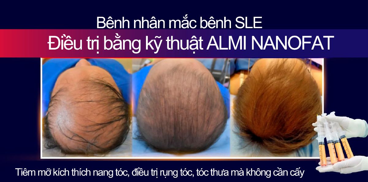 Review cấy tóc và điều trị bệnh nhân thực không chỉ có việc sử dụng Influencer