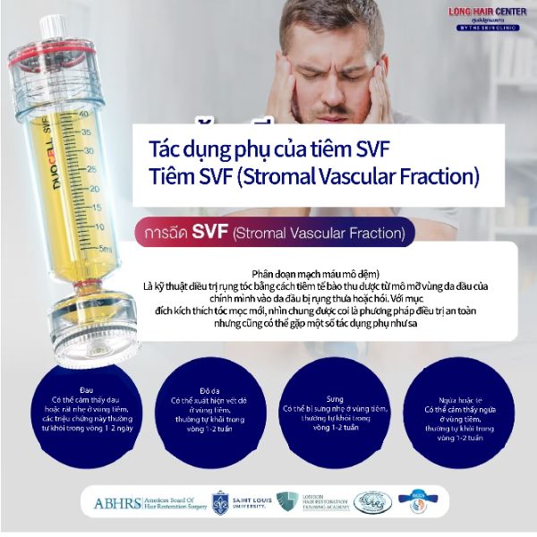 ALMI Nano Fat & SVF – Tăng mật độ tóc bằng tế bào mỡ